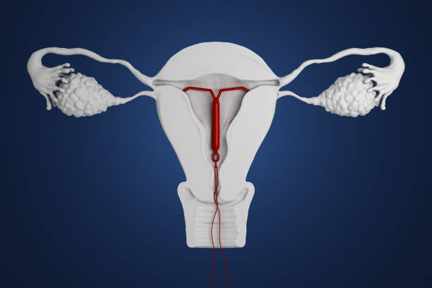 Risks Associated With IUDs